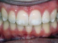 флюороз зубов различной степени тяжести