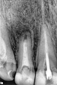 Временное пломбирование корневого канала 12 зуба кальцийсодержащей пастой Metapex