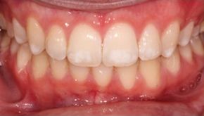 Начальная форма развития флюороза зубов