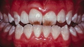 Меловидно-крапчатая форма флюороза зубов