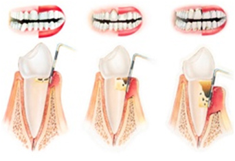 Разрушение зубов-десневого соединения и образование костного кармана