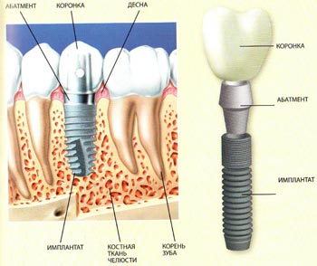 зубной имплантат