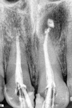Временное пломбирование корневого канала 11 и 12 зуба кальцийсодержащей пастой Metapex
