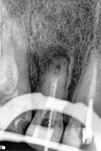 Перелечивание 12 зуба под резекцию верхушки корня