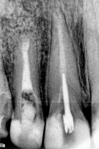 Контрольный снимок 12 зуба после резекции верхушки корня