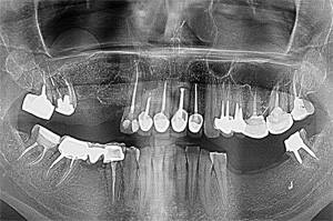 Отсутствуют жевательные зубы нижней челюсти слева, атрофия костной ткани по ширине, узкий гребень