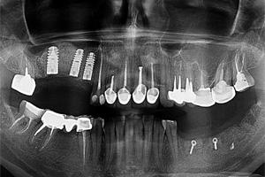 Проведена пересадка костных блоков, на рентгенограмме видны фиксирующие винты