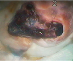 Зуб 26. Перфорация между щечными каналами зуба, пролеченного резорцин-формалиновым методом. 