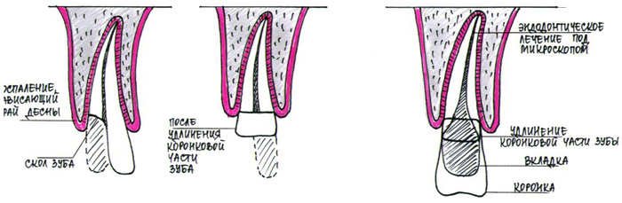 Чтобы сохранить зуб и его функцию необходимо восстановить коронковую часть зуба при помощи ортопедической конструкции