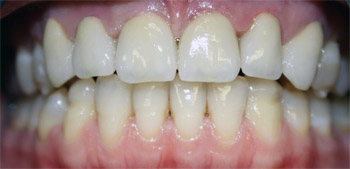 После лечения. Протезирование фронтальной группы зубов керамическими коронками на базе фрезерованного диоксида циркония.