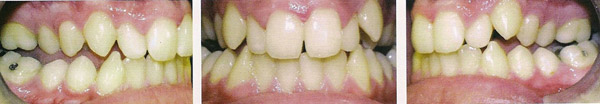 Состояние зубов до начала ортодонтического лечения