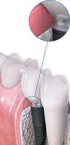 Гигиенический уход за имплантатами и зубными протезами
