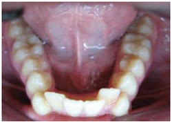 Деформации зубного ряда