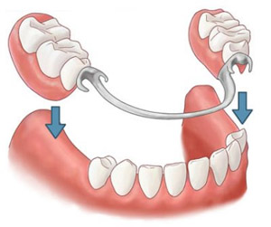 Частично-съемный зубной протез - стоматологическая ортопедическая конструкция