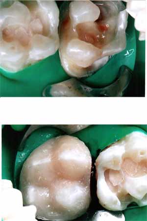 нарушение формы коронковой части зуба