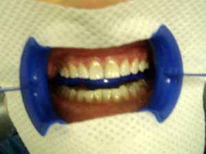 Результаты отбеливания зубов с применением системы Zoom3