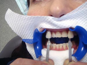 Результаты отбеливания зубов с применением системы Zoom3