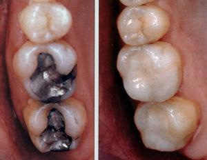 Вкладки в стоматологии показания противопоказания thumbnail