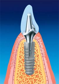 Как долго служат зубные имплантаты?