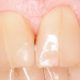 Трещины и расколы коронковой и корневой части зубов, причины возникновения, прогноз лечения.