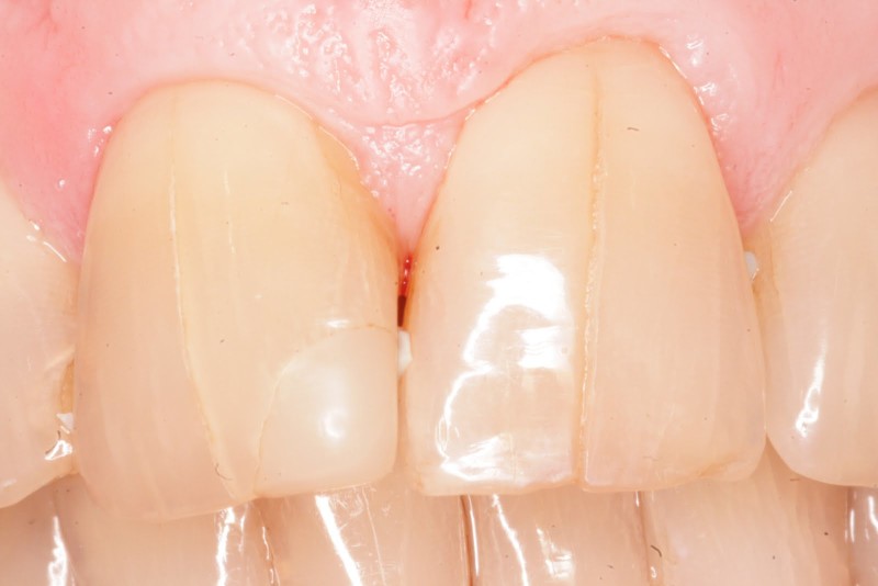 Трещины и расколы коронковой и корневой части зубов, причины возникновения, прогноз лечения.