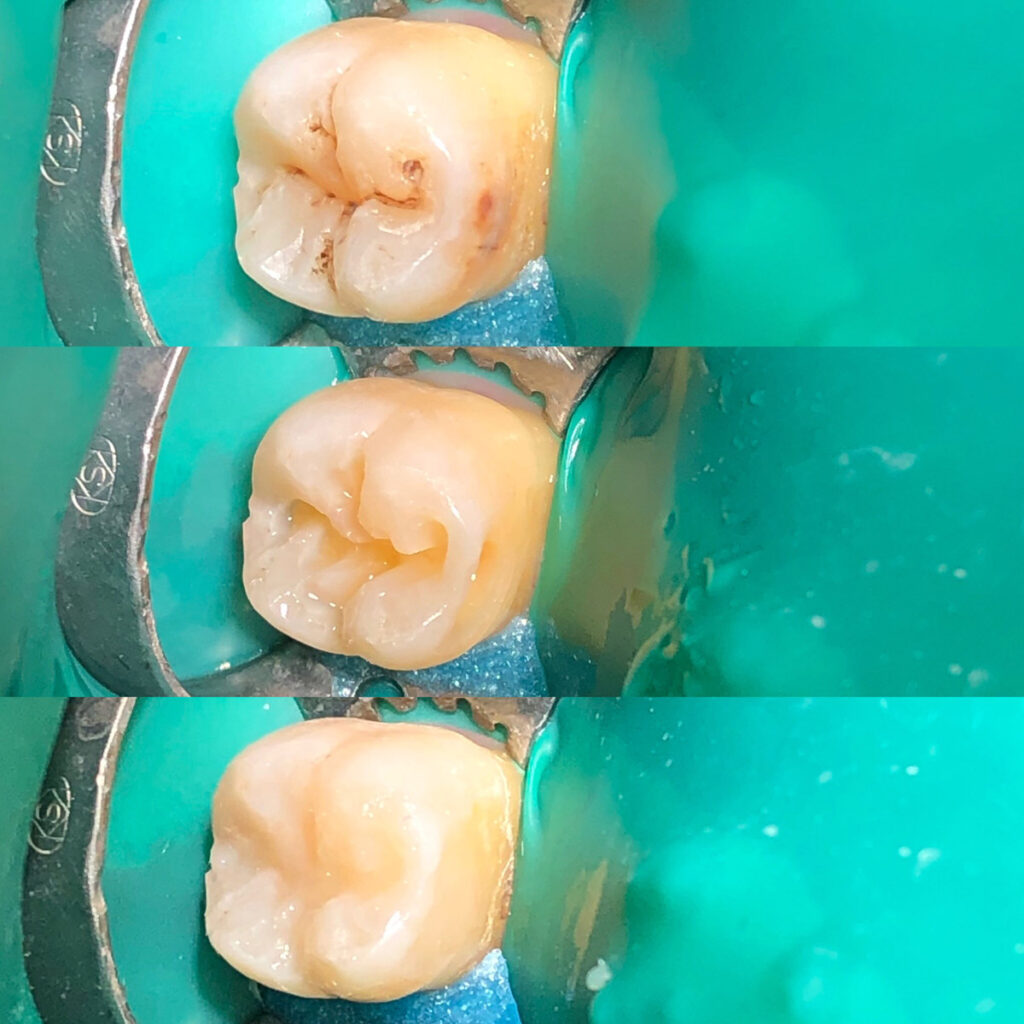 Косметическая реставрация зубов после лечения кариеса