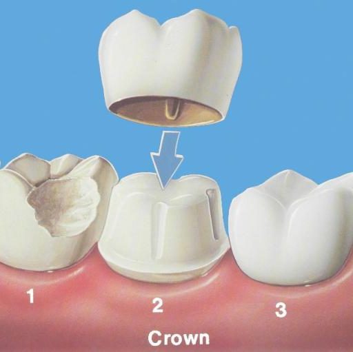 Что такое зубная коронка (искусственная)?