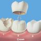 Что такое зубная коронка (искусственная)?