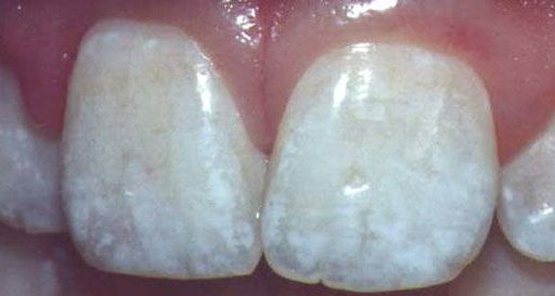 Флюороз зубов: причины, формы и лечение