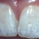 Флюороз зубов: причины, формы и лечение
