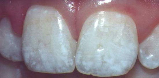 Флюороз зубов: причины, формы и лечение