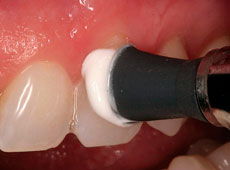 Средства, применяемые для насыщения поверхности зуба минеральными компонентами