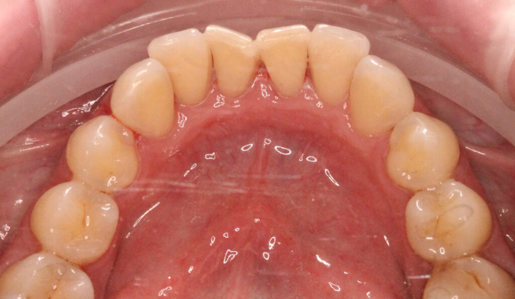 Особенности гигиенического ухода за имплантатами и зубными протезами
