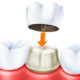 Может ли использоваться трехчетвертная коронка в качестве опорного зуба для несъемного мостовидного зубного протеза?