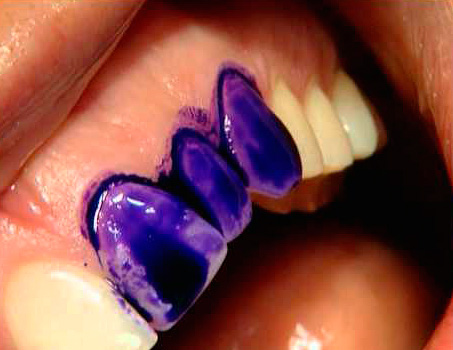 Красители для выявления зубных отложений