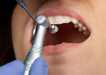 Средства, применяемые при профессиональной чистке зубов, удалении зубных отложений