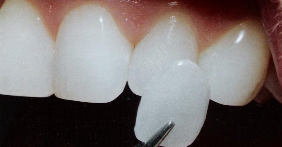 Какие методы осветления жизнеспособных зубов используются наиболее часто?