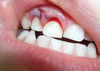 Как лечить травматическое вколачивание молочного резца, каковы возможные последствия травмы молочного зуба?