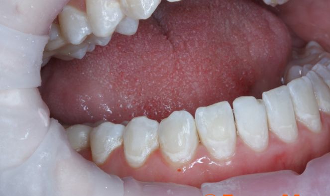 Что является основным компонентом зубного налета, как быстро он образуется, основные типы зубного налета, как они отличаются по составу?