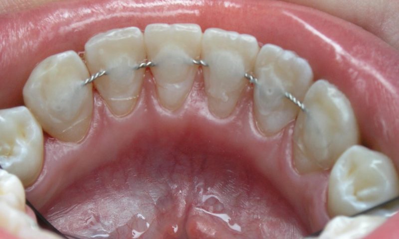 шинирование зубов
