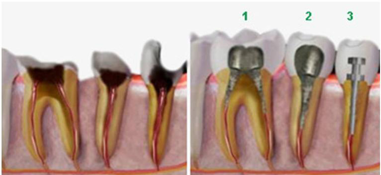 Стоимость полного восстановления коронки зуба 