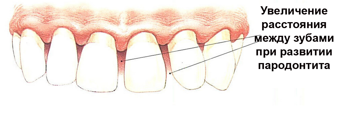 При пародонтите средней и тяжелой тяжести подвижность зубов