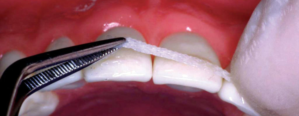 Проведение процедуры шинирования зубов