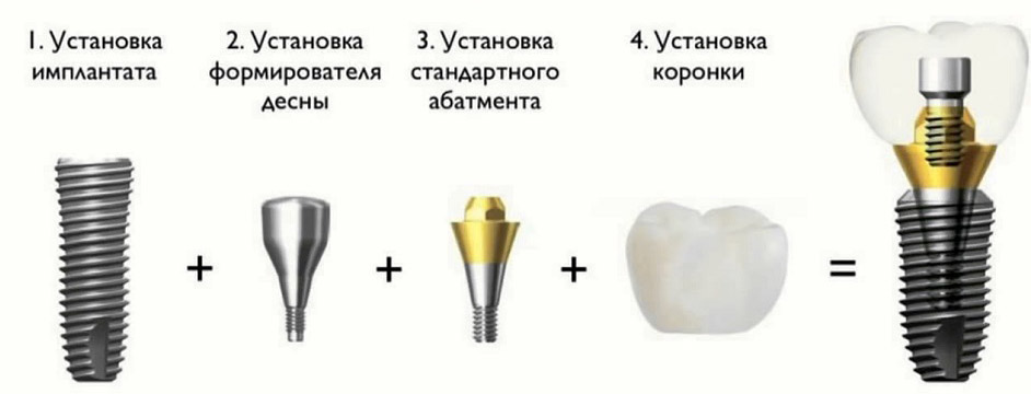 Корейские имплантаты Дентиум (Dentium) с коронкой по выгодной цене 52.000 рублей!