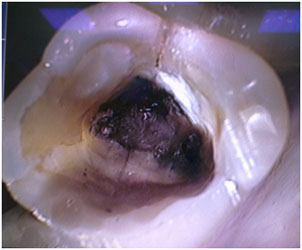 Зуб 26. Продольная трещина – раскол зуба.