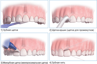 Одиночный зуб с опорой на имплантат